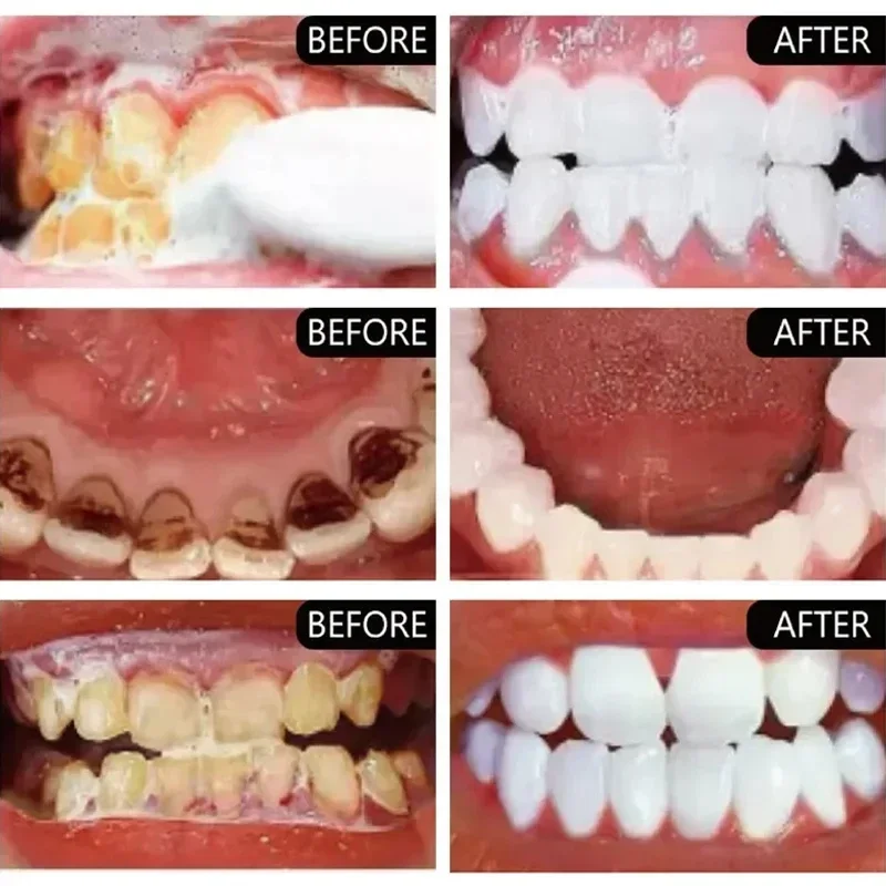 Rimozione rapida delle macchie - Teeth Whitening Fast recensione e prezzo