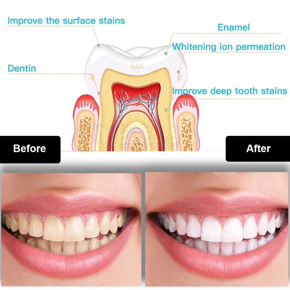 Kit per sbiancamento dei denti - Teeth Whitening Pens recensione e prezzo